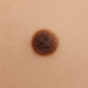 épilation laser et grains de beauté