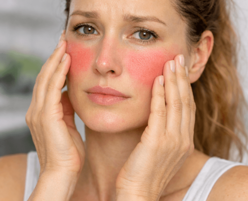 Pourquoi j’ai les joues rouges en permanence ? Causes possibles et solutions
