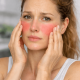 Pourquoi j’ai les joues rouges en permanence ? Causes possibles et solutions
