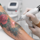 Détatouage couleur : peut-on enlever toutes les encres ?