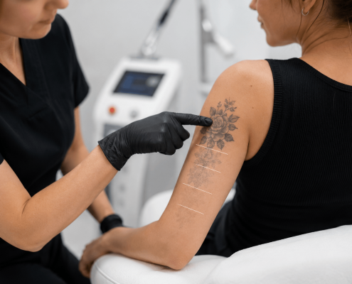 Peut-on enlever un tatouage sans cicatrice ?